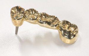 металический мост на зубы протез фото