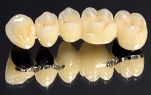 металлокерамика зубные мосты фото