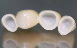 пластмассовый пластиковый мост на зубы протез фото
