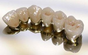 металлокерамика протез на зубы фото