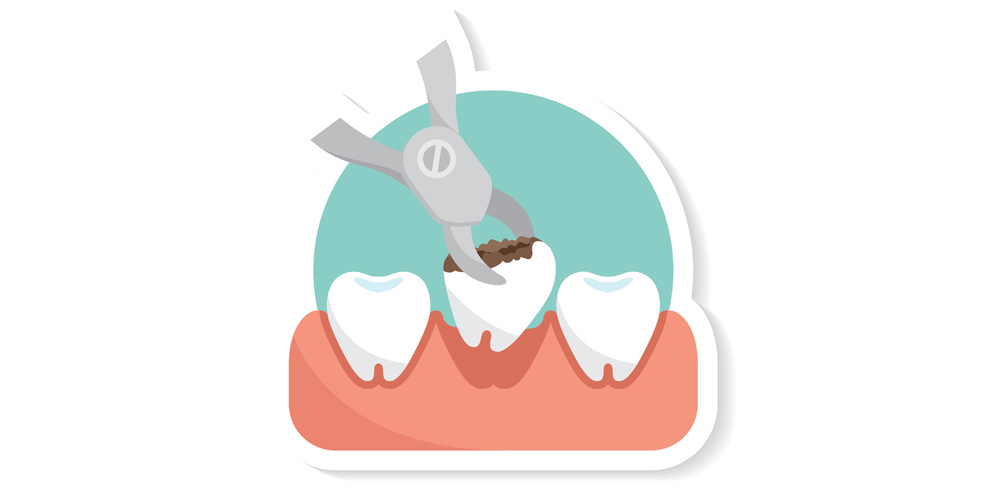 Стоматология дальнегорск. Удалённый зуб в зубной. Вырывают зуб иллюстрация.